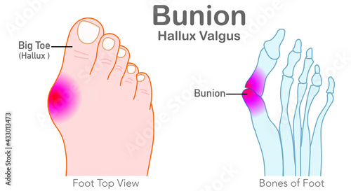 Bunion, Hallux valgus. Foot bones, joint deformed feet. Top view of the foot, angle of the big toe. Orthopedic treatment, scalloped shoes. Illustration medical draw vector