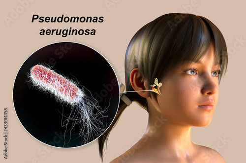 Pseudomonas aeruginosa bacterium as a cause of otitis media photo