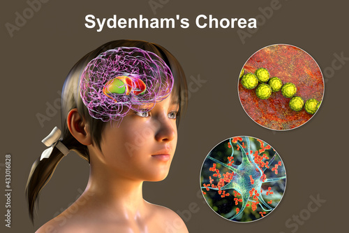 Sydenham's chorea, an autoimmune disease that results from Streptococcus infection photo