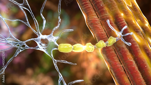 Demyelination of neuron, the damage of the neuron myelin sheath seen in demyelinating diseases photo