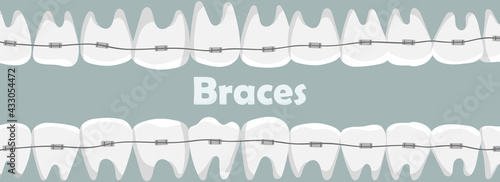 Banner with teeth in braces with the inscription.