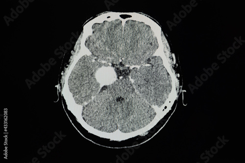 CT brain scan showing meningioma at right cavernous sinus.