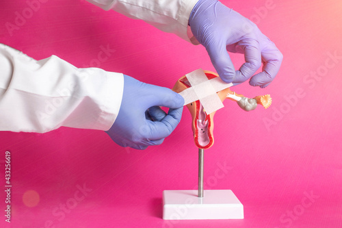 The doctor holds a medical plaster near the model of the girl's gynecological system on a pink background. Sexually Transmitted Disease Treatment Concept, Infection