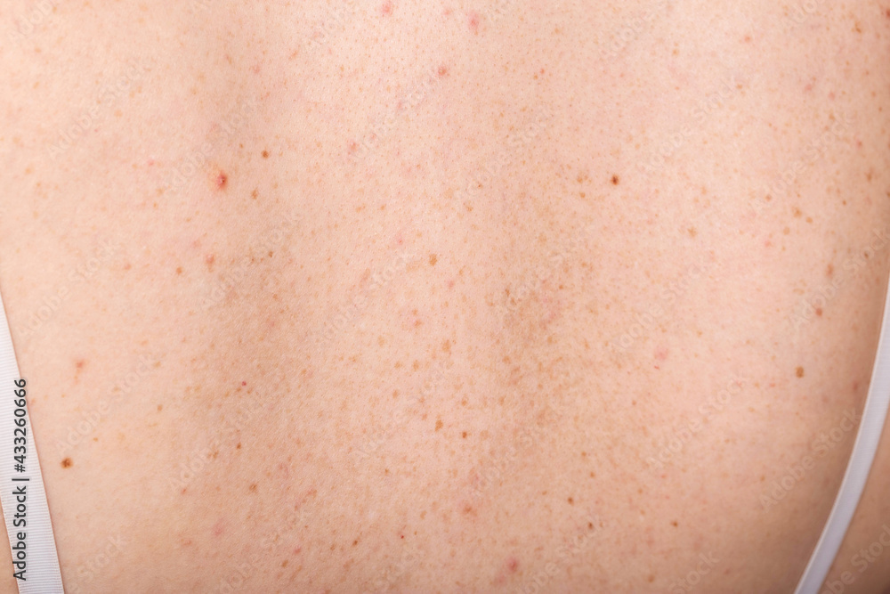 Pigmented spots and pimples on the skin of the girl's back. Dermatology and allergy concept, close-up Pigmented spots and pimples on the skin of the girl's back. Dermatology and allergy concept, close-up