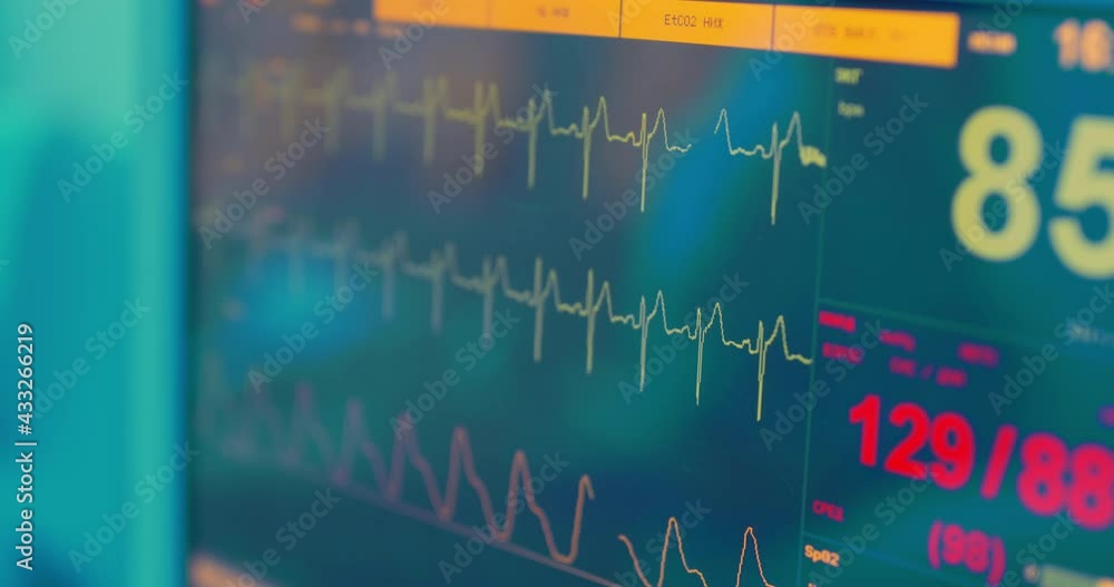 Closeup patient's monitor screen with diagrams electrocardiogram
