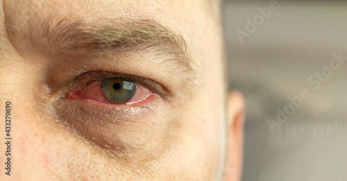 Close-up of a red and inflamed eye
