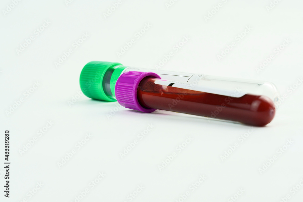 Vacuum tubes for collection and blood samples on white background. Transparent tubes with purple and green lid. Label to identify the data. Selective focus. Vacuum tubes for collection and blood samples on white background. Transparent tubes with purple and green lid. Label to identify the data. Selective focus.