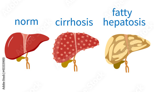 liver and liver disease. cirrhosis of the liver, hepatitis, fatty hepatosis. stock vector illustration.
