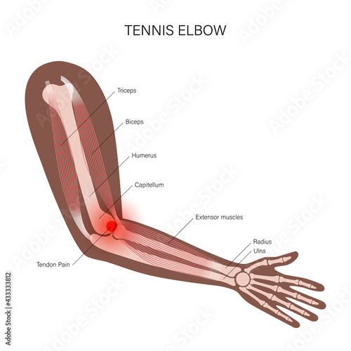 Lateral epicondylitis tennis elbow photo