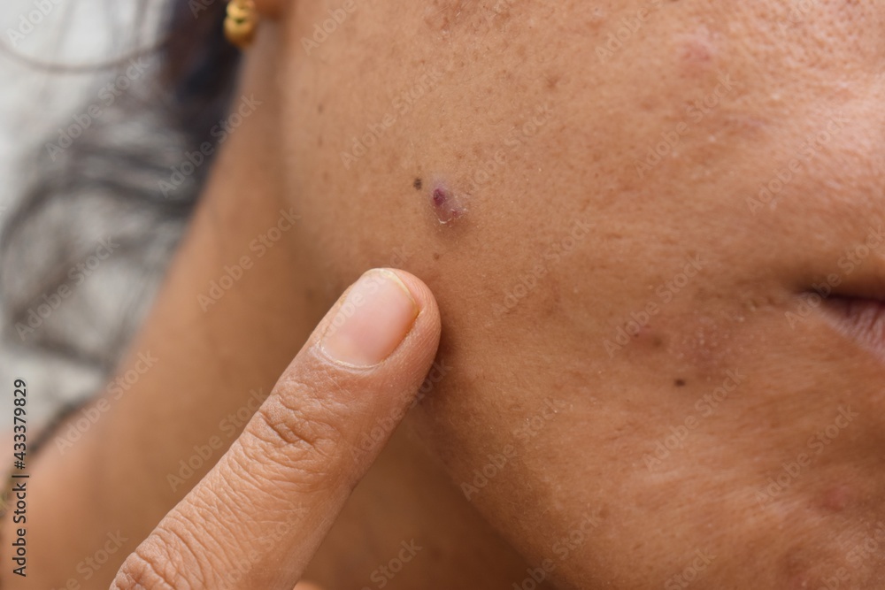 acne or pimple on face closeup acne or pimple on face closeup