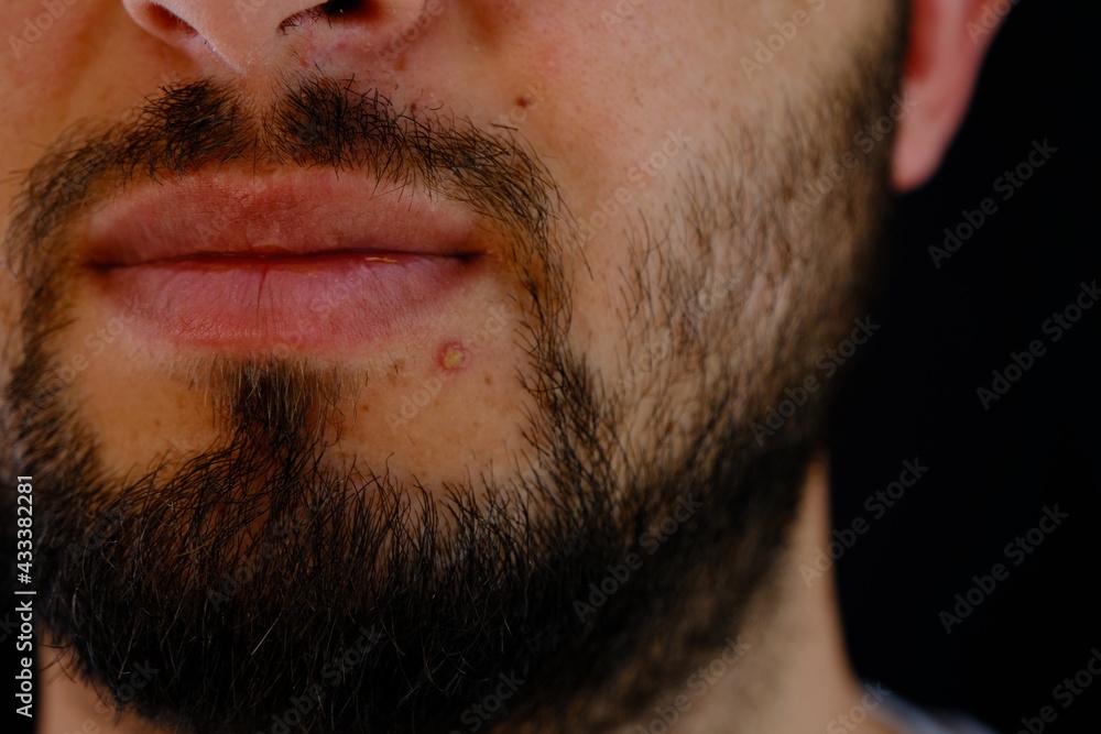 close up of acne on the face of a bearded young man.