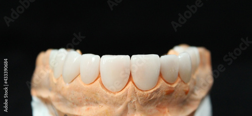 Wallpaper Mural Dental veneers in the plaster model. Smile makeover Torontodigital.ca