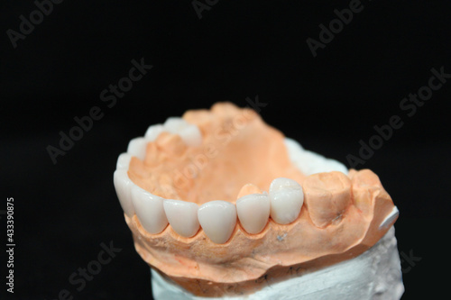 Wallpaper Mural Dental veneers in the plaster model. Smile makeover Torontodigital.ca