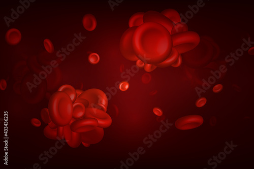 Blood clots, thrombus or embolus with coagulated erythrocytes.