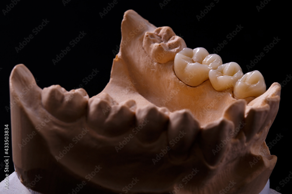 Mold of teeth. Gypsum model plaster of teeth. Stomatologic plaster cast, molds of human jaws and teeth on black background. Dentistry and orthodontics concept