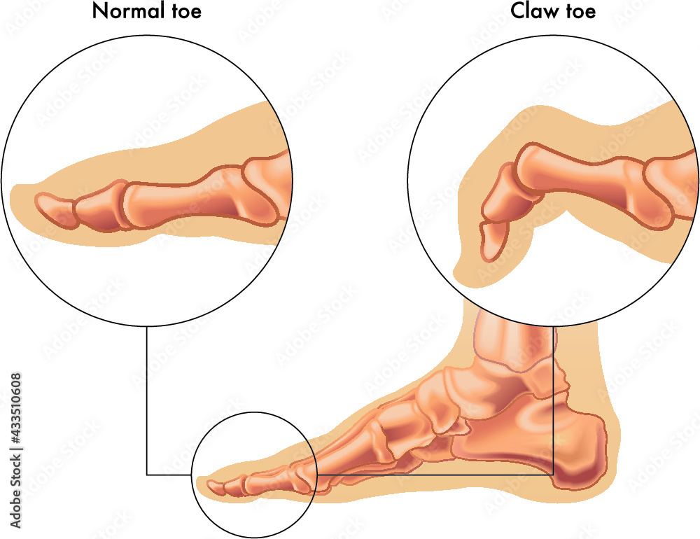 Medical illustration shows the difference between a normal toe and a
