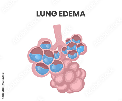 Lung edema illustration. Water collecting inside alveolar lumen