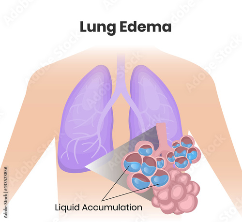 Lung edema illustration. Water collecting inside alveoli