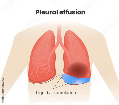 Lobar pneumonia with pleural effesion.