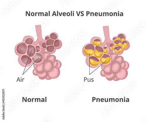 Normal lung alveoli versus pneumonia.