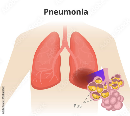 Pneumonia. Left lobar pneumonia. close up of the lung alveoli with pus