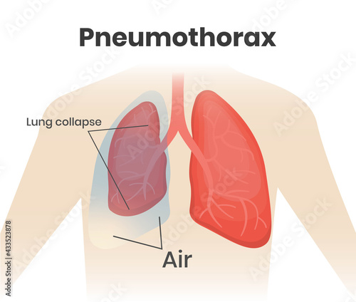 Pneumothorax illustration. Right lung collapse and air build up in a pleural cavity
