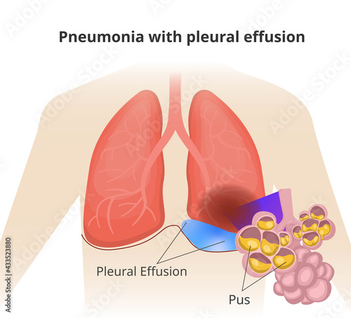Pneumonia with pleural effusion. Close up of the alveioli with pus