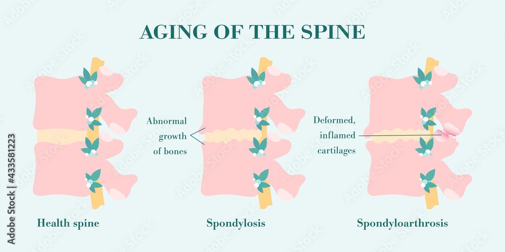 Spondylosis, bone growth of vertebral column that one of causes of the low back pain. Facet joint arthrosis, deformed and inflamed processes. Spinal disease, aging spine compared with healthy