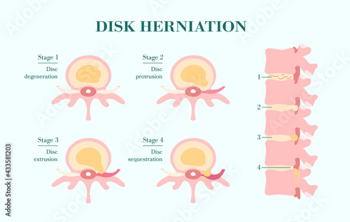 Herniated spinal disc - Degenerative, Protrusion, Extrusion, Sequestration - vector patient-friendly diagram, hand drawn. Infographic of stages hernia of intervertebral disk