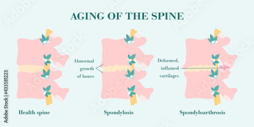 Spondylosis, bone growth of vertebral column that one of causes of the low back pain. Facet joint arthrosis, deformed and inflamed processes. Spinal disease, aging spine compared with healthy photo