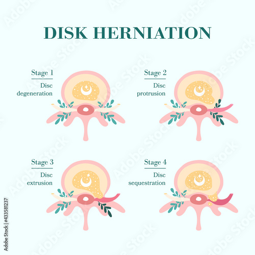 Herniated spinal disc - Degenerative, Protrusion, Extrusion, Sequestration - vector patient-friendly diagram, hand drawn. Infographic of stages hernia of intervertebral disk