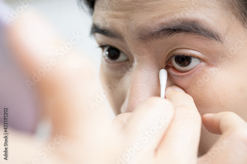Принти на полотні Female using a cotton bud swab to wipe clean the swollen,itchy area,problems of