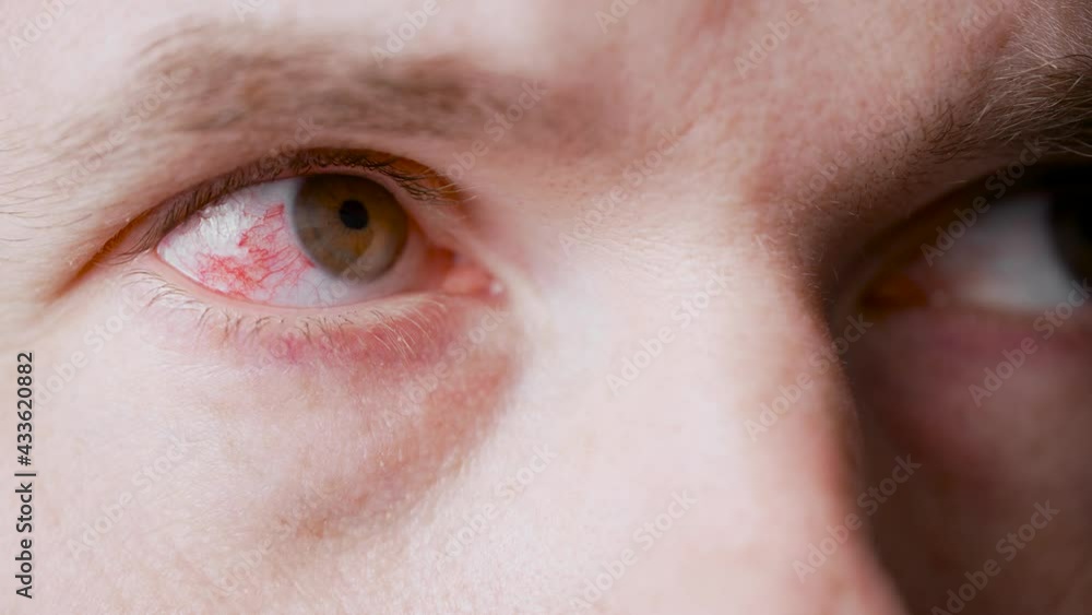 The man overworked and was very tired, his eyes were inflamed. The man overworked and was very tired, his eyes were inflamed.