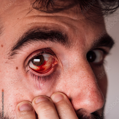 Closeup of crop male with red inflamed eye looking at camera and touching face
