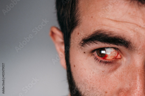 Closeup of crop male with red inflamed eye looking away