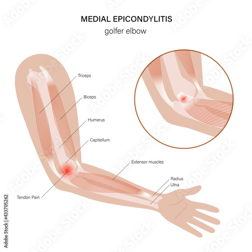 Medial epicondylitis golfer elbow photo