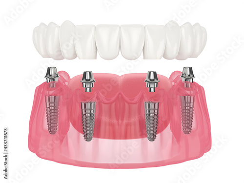 Fotografie Mandibular prosthesis all on 4 system supported by implants