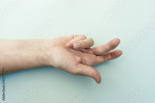 Hands of a woman with twisted fingers. Dupuytren's contracture disease.