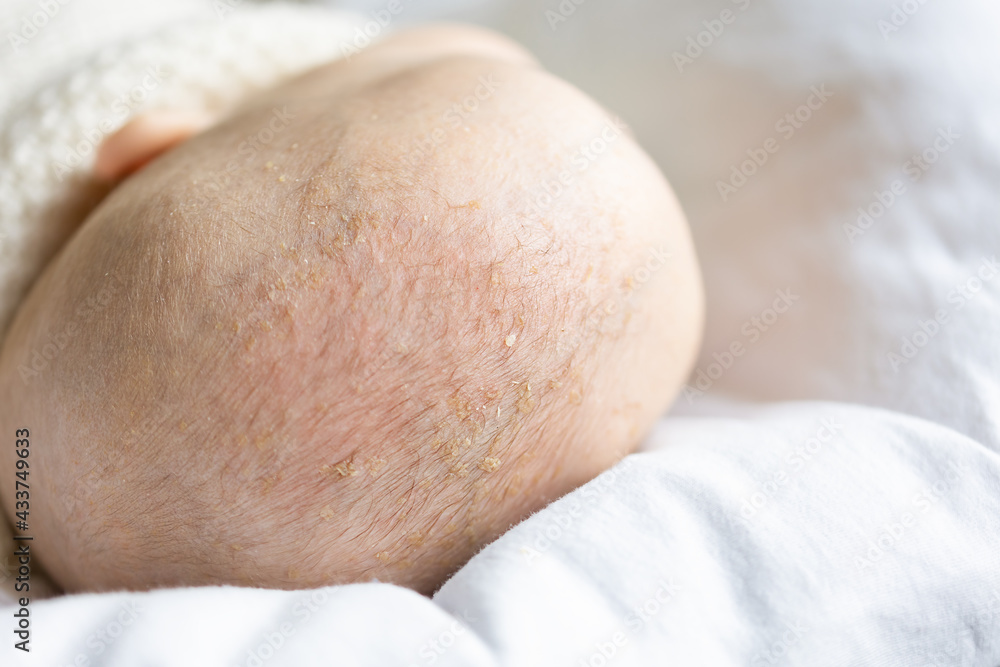 seborrheic dermatitis patches on baby's scalp hair close-up view seborrheic dermatitis patches on baby's scalp hair close-up view