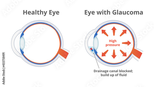 Vector illustration of a damaged eye with glaucoma and normal healthy eye isolated. High pressure in the eye damages optic nerves, drainage canal blocked, aqueous humor fluid is build up in the eye.