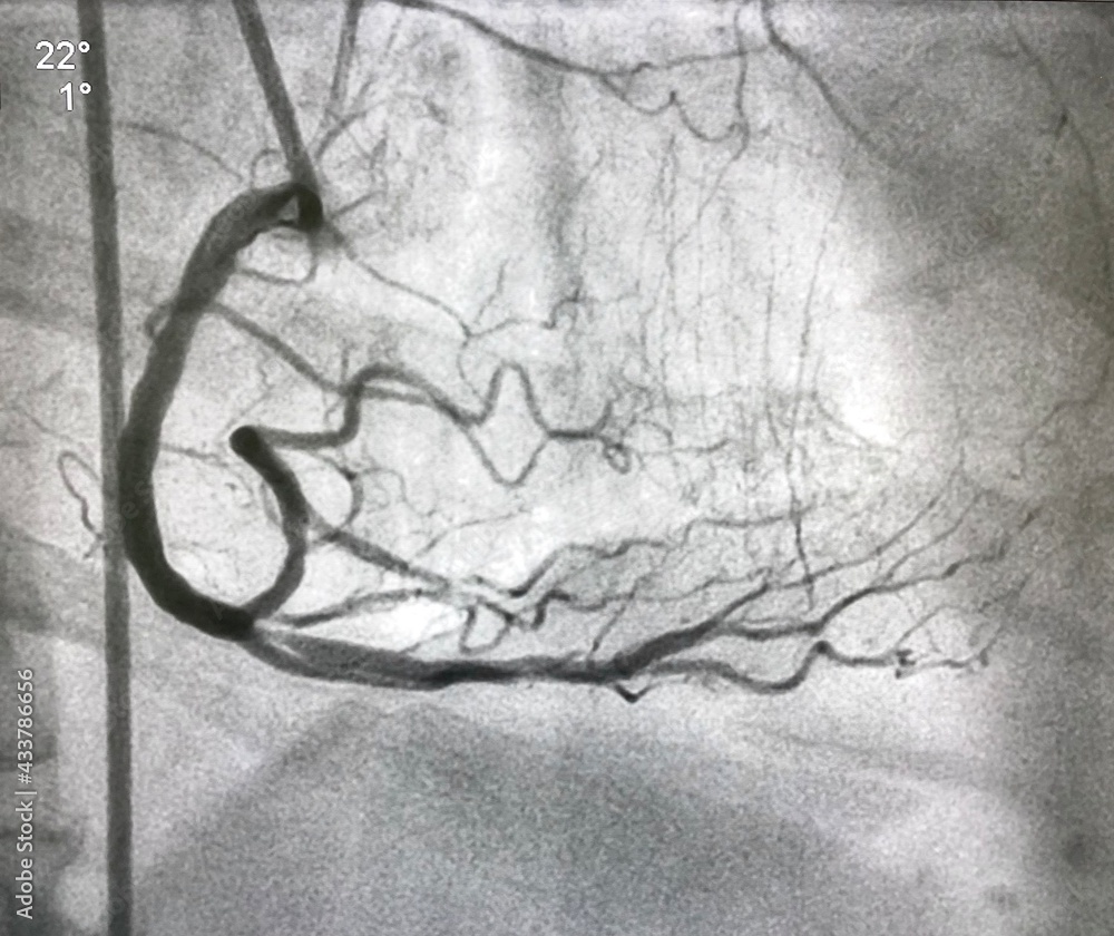 coronary angiogram showed right coronary artery (RCA) given collateral to left anterior descending artery (LAD) that had chronic total occlusion (CTO). - obrazy, fototapety, plakaty 