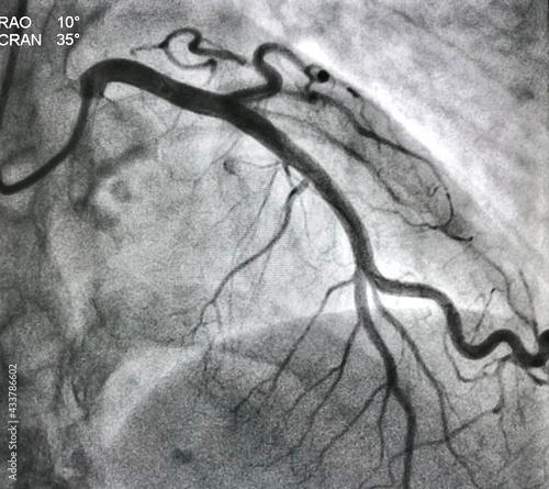 Fotografia Normal coronary angiogram of left coronary artery during cardiac catheterization
