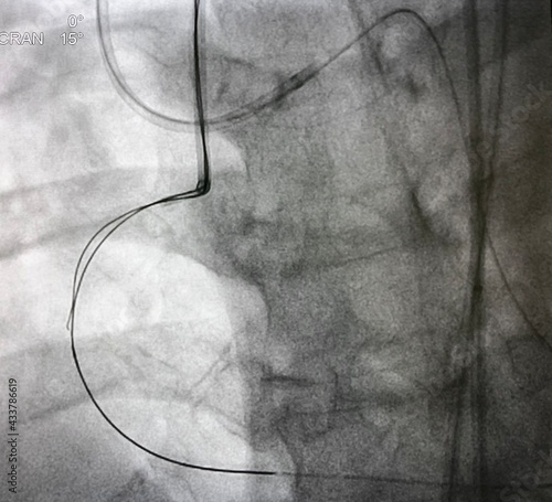 Retrograde guide wire to right coronary artery (RCA) in coronary chronic total occlusion (CTO) lesion during percutaneous coronary intervention (PCI). photo