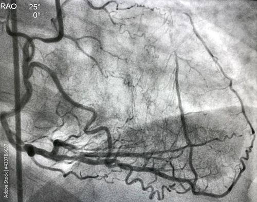 coronary angiogram showed right coronary artery (RCA) given collateral to left anterior descending artery (LAD) that had chronic total occlusion (CTO). photo