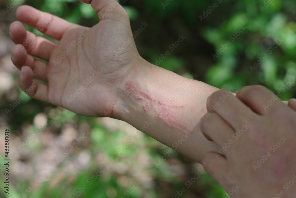 A woman scratching very itchy poison ivy on her wrist and arm A woman scratching very itchy poison ivy on her wrist and arm