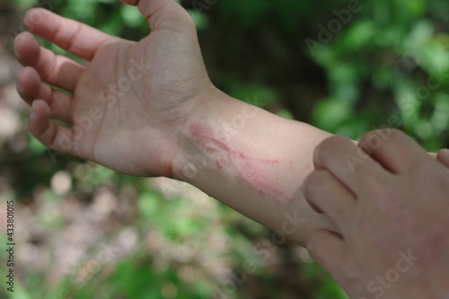 Foto A woman scratching very itchy poison ivy on her wrist and arm