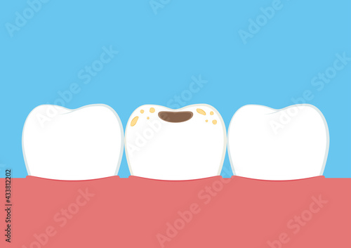 Teeth cartoon vector. dental equipment vector. Tartar buildup are common dental. Tooth cavity.