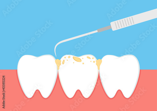 Teeth cartoon vector. dental equipment vector. Tartar buildup are common dental. Tooth cavity.