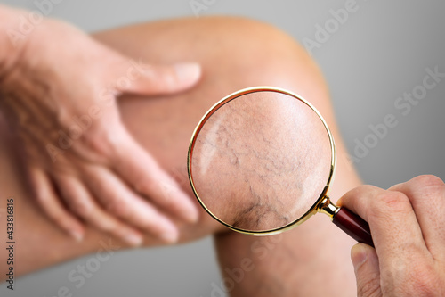 Foto Leg Vein Varicose Disease And Pain