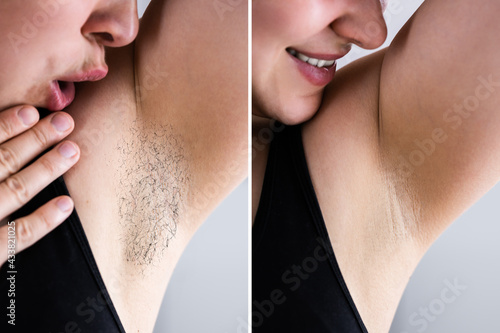 Before After Laser Hair Removal photo